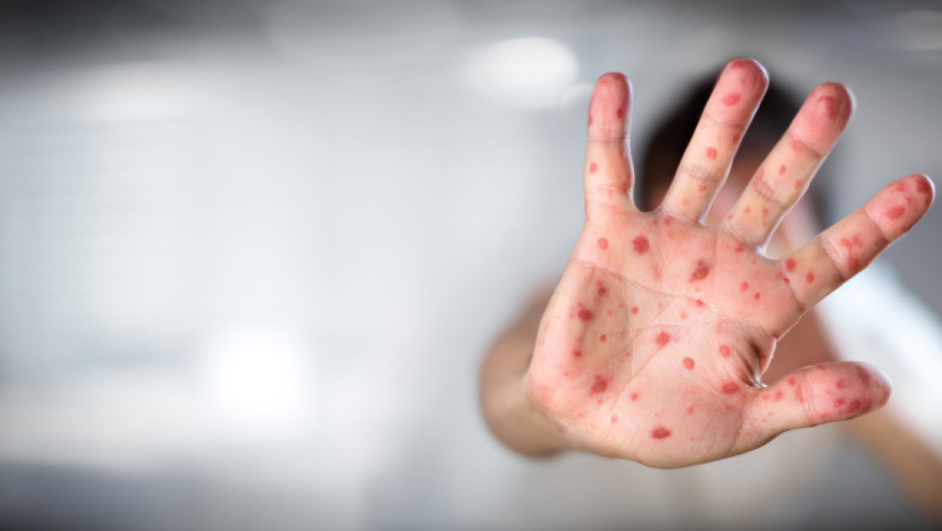Moartea unui copil bolnav de rujeolă a stârnit un val de conspirații antivacciniste în Marea Britanie