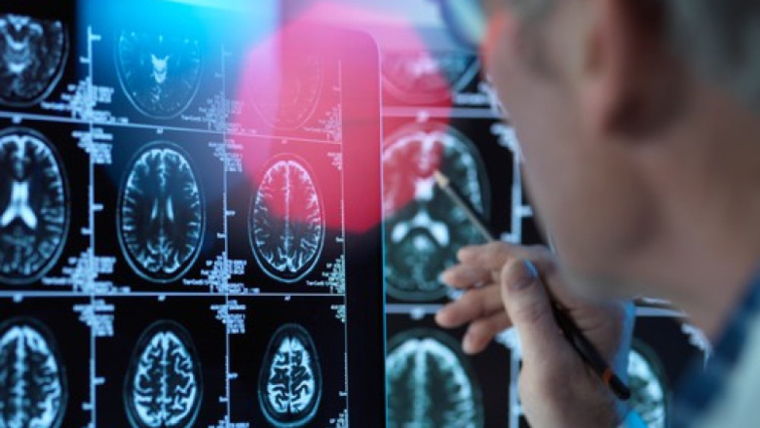 Un medicament pentru tratarea bolii Alzheimer în stadii timpurii este aproape de autorizare în UE. Ce este donanemab